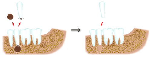 歯の再植術