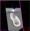 CT写真と顎の模型を組み合わせた分析画像2