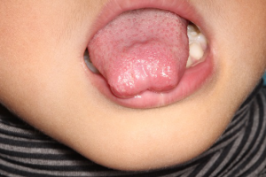 舌小帯が短く、舌が前に出せません