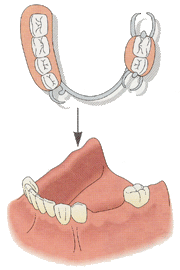 奥歯を固定するために、金属の支えを使用する例