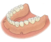 総入れ歯の場合、入れ歯を固定する力が弱く、ぐらついたり、ずれたりします