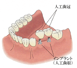 インプラントでは、両隣の歯はそのままで、負担もかかりません