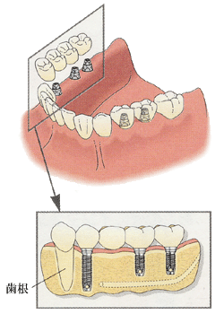 インプラントでは失われた歯根部分の骨を支えにして人工の歯を固定