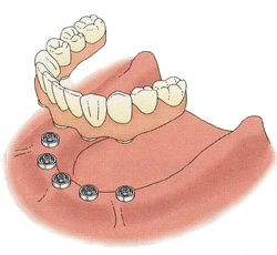 インプラントでは、義歯はあごの骨に固定され、力を入れて噛むことができます