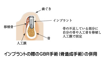 GBR手術（骨造成手術）の併用