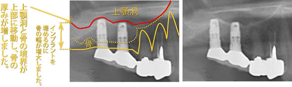 上顎洞挙上術(サイナスリフト)の併用後