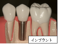インプラント