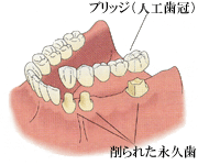 この形のブリッジでは、周りの歯を大きく削らなければなりません