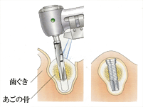 あごの骨にインプラントを埋め込みます