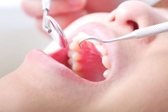 普通の抜歯と親知らずの抜歯の違いは？