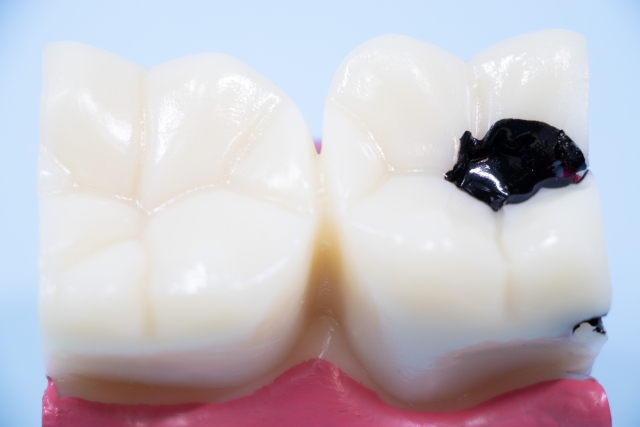 知覚過敏と虫歯、どう違う?